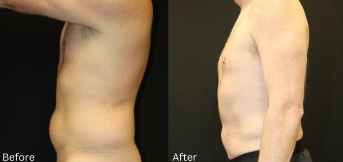 Before & After CoolSculpting Case 223 View 2 View in Santa Rosa, California