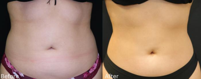 Before & After CoolSculpting Case 224 View 1 View in Santa Rosa, California
