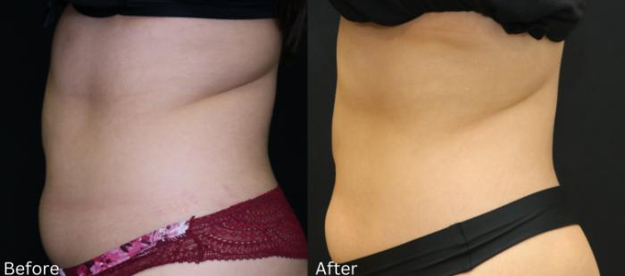 Before & After CoolSculpting Case 224 View 2 View in Santa Rosa, California
