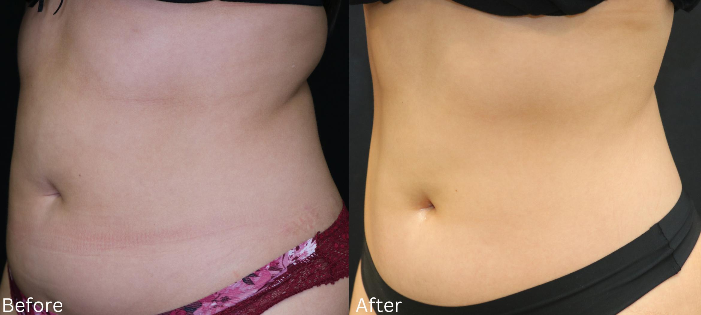 Before & After CoolSculpting Case 224 View 3 View in Santa Rosa, California