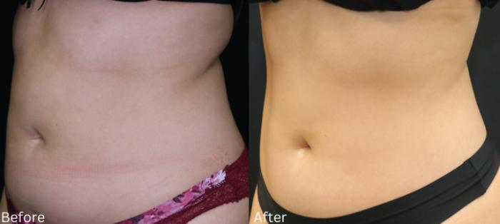 Before & After CoolSculpting Case 224 View 3 View in Santa Rosa, California