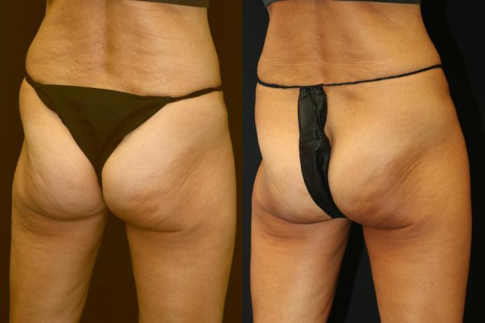 Before & After CoolSculpting Case 225 View 1 View in Santa Rosa, California