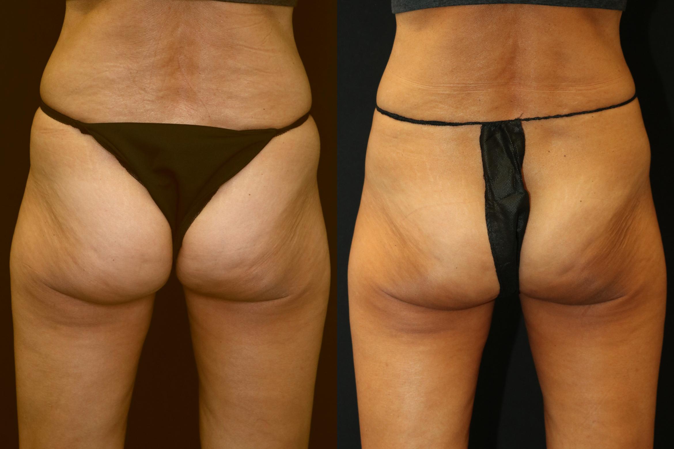 Before & After CoolSculpting Case 225 View 2 View in Santa Rosa, California