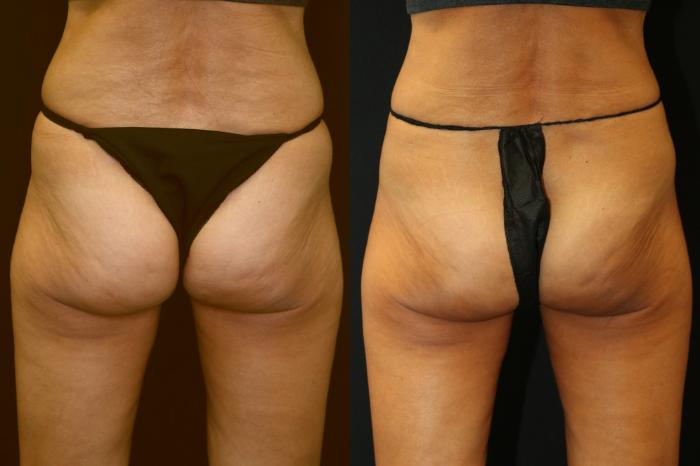 Before & After CoolSculpting Case 225 View 2 View in Santa Rosa, California