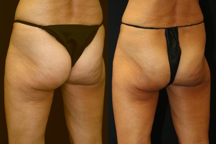 Before & After CoolSculpting Case 225 View 3 View in Santa Rosa, California
