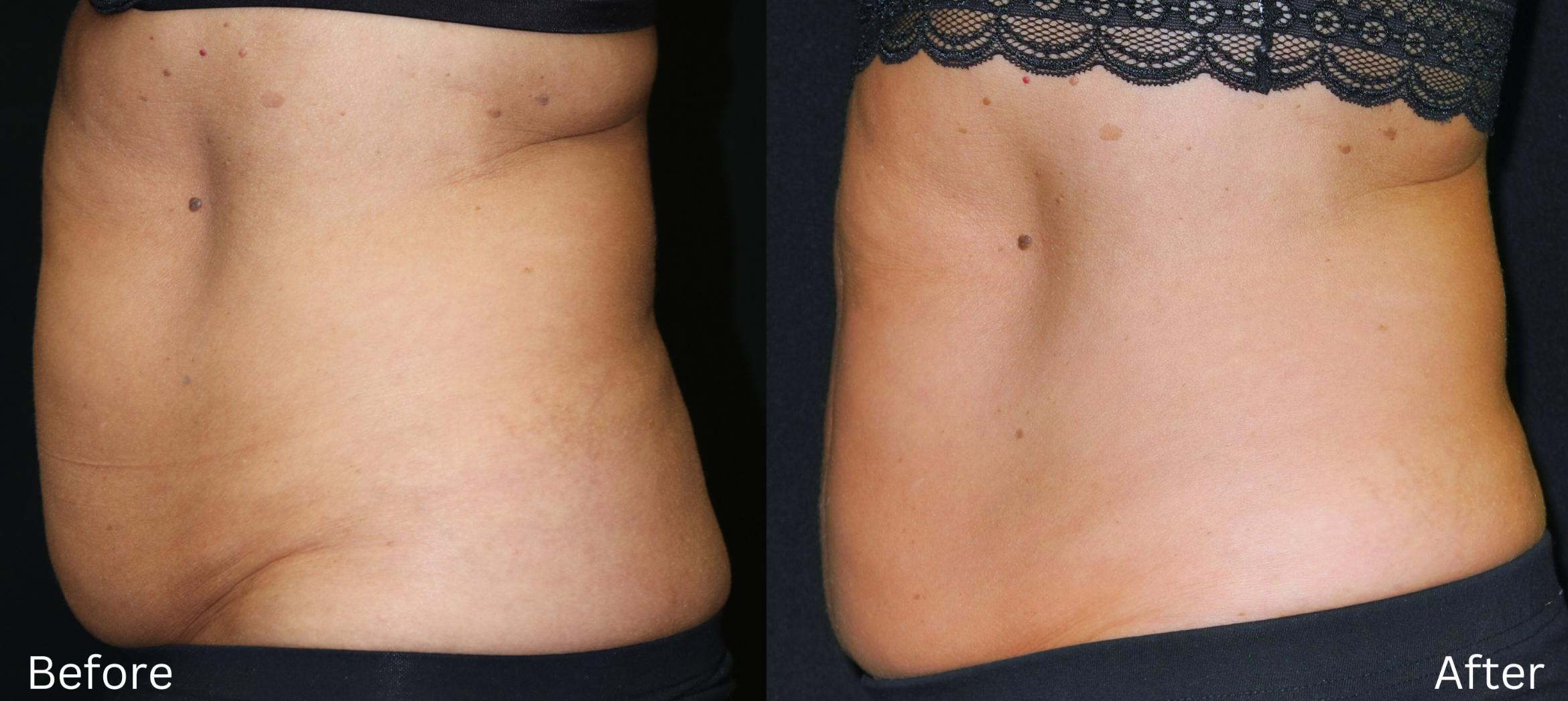 Before & After CoolSculpting Case 226 View 1 View in Santa Rosa, California