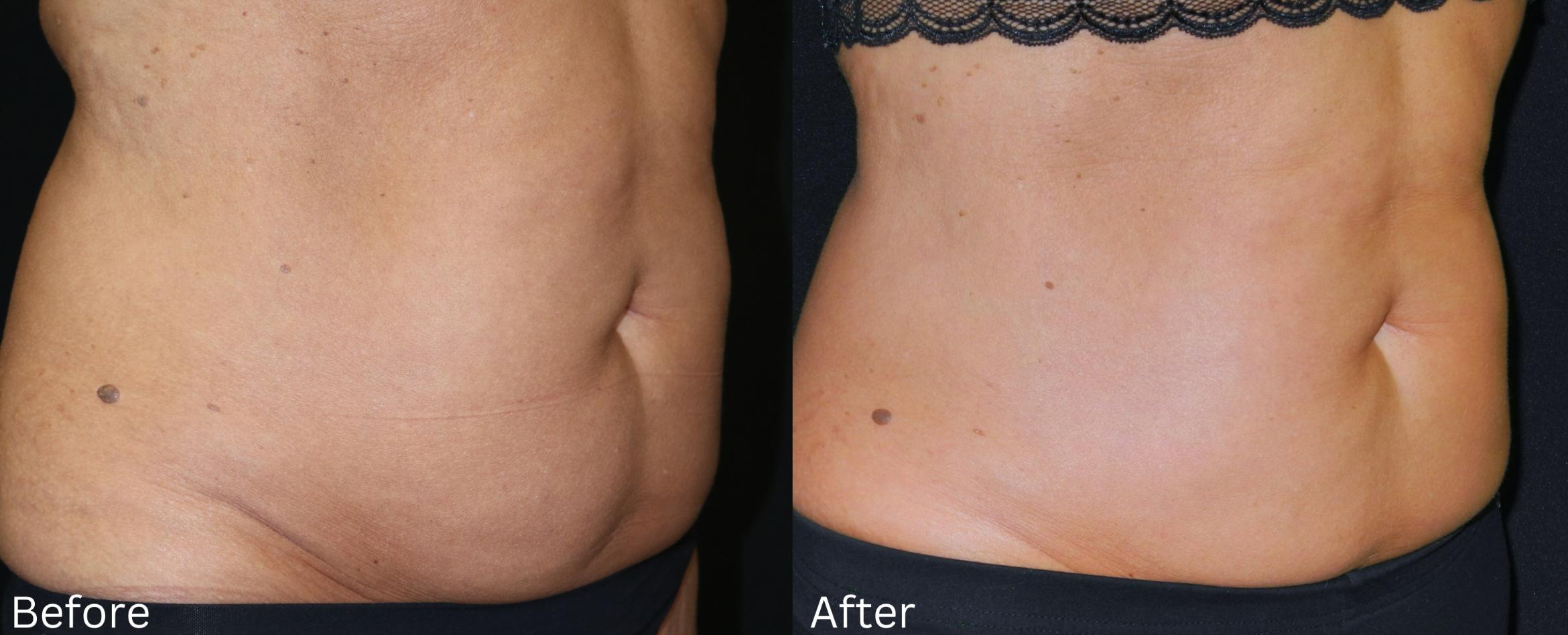 Before & After CoolSculpting Case 226 View 2 View in Santa Rosa, California