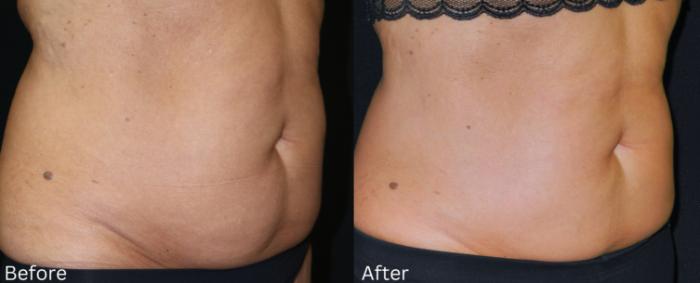 Before & After CoolSculpting Case 226 View 2 View in Santa Rosa, California