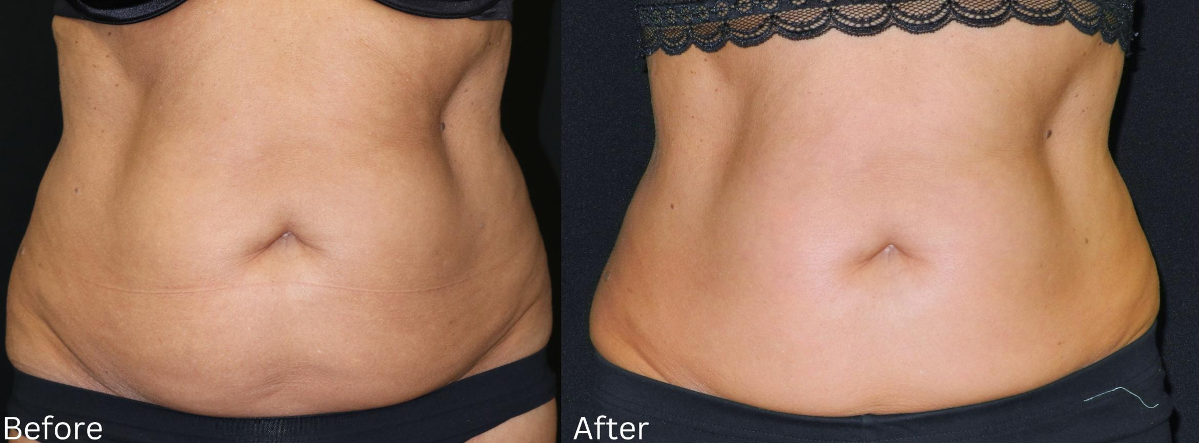 Before & After CoolSculpting Case 226 View 3 View in Santa Rosa, California