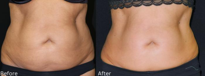 Before & After CoolSculpting Case 226 View 3 View in Santa Rosa, California