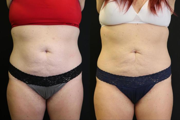 Before & After CoolSculpting Case 378 View 1 View in Santa Rosa, California