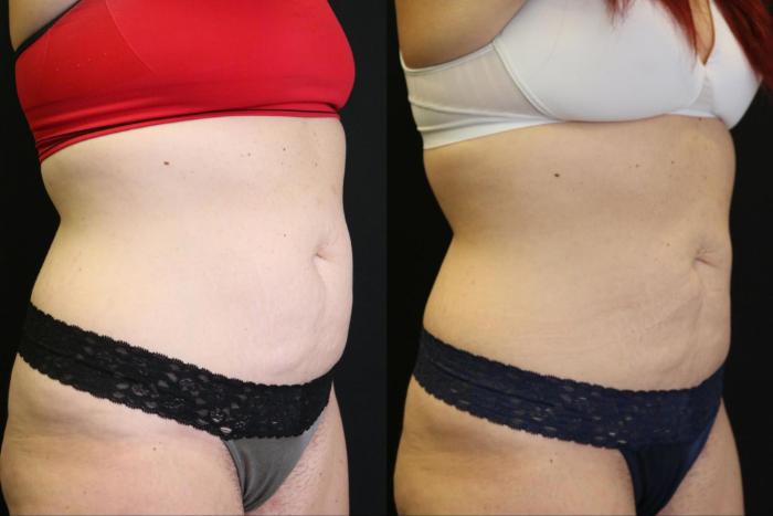 Before & After CoolSculpting Case 378 View 2 View in Santa Rosa, California