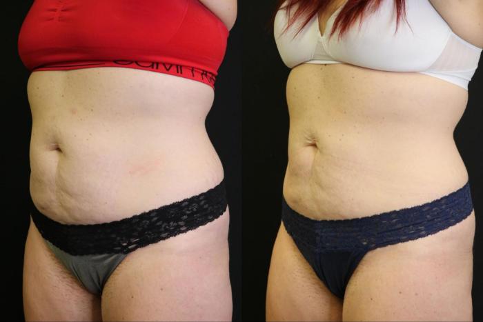Before & After CoolSculpting Case 378 View 3 View in Santa Rosa, California