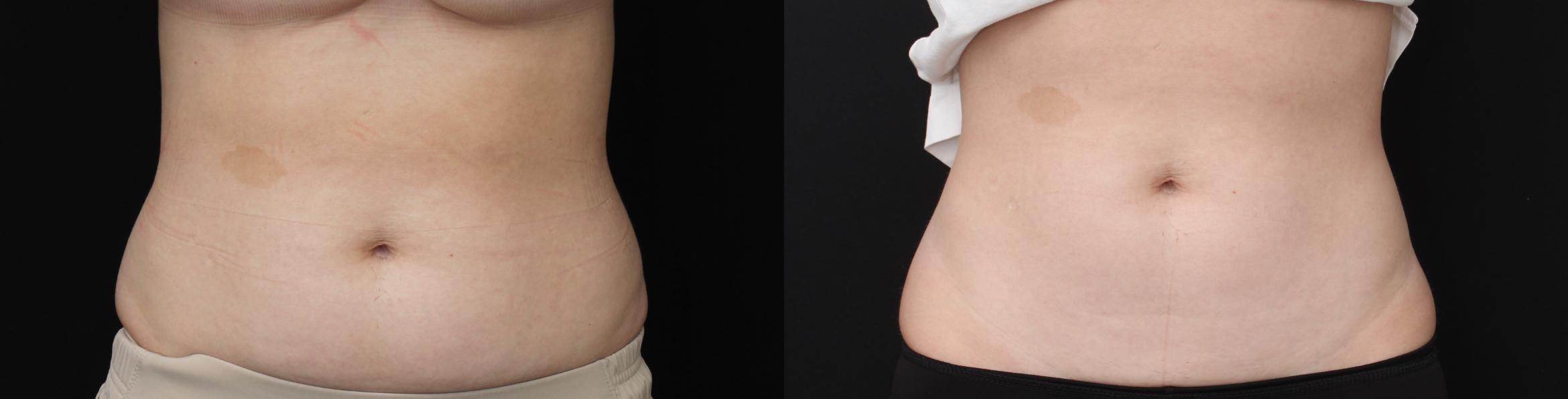 Before & After CoolSculpting Case 427 Front View in Santa Rosa, California