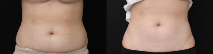 Before & After CoolSculpting Case 427 Front View in Santa Rosa, California