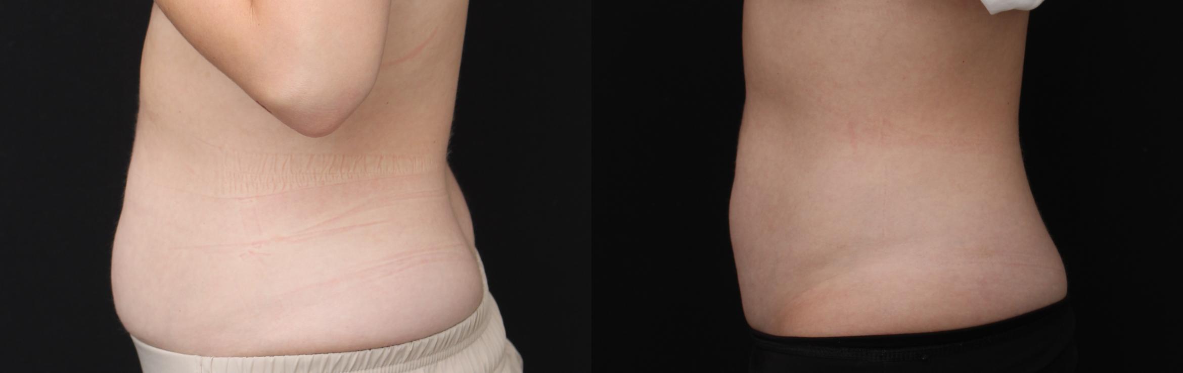 Before & After CoolSculpting Case 427 Left Side View in Santa Rosa, California