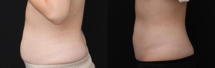 Before & After CoolSculpting Case 427 Left Side View in Santa Rosa, California