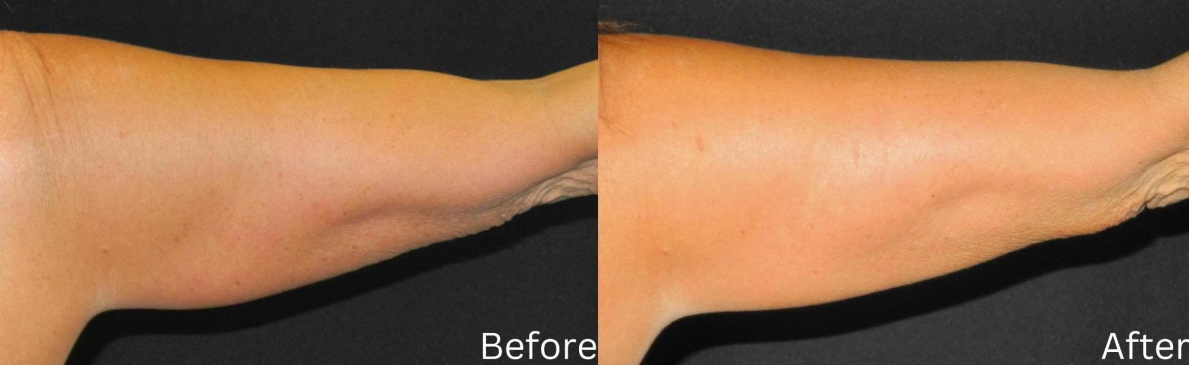 Before & After CoolSculpting Case 72 View 1 View in Santa Rosa, California