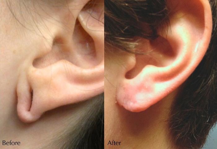 Before & After Earlobe Repair Case 298 View 1 View in Santa Rosa, California
