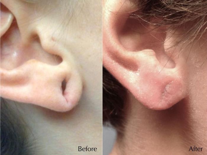 Before & After Earlobe Repair Case 299 View 1 View in Santa Rosa, California