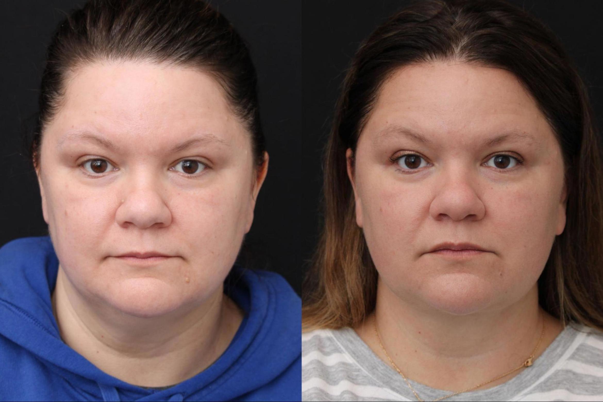Before & After Ellevate Neck Contouring Case 380 View 1 View in Santa Rosa, California