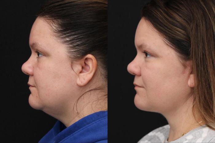 Before & After Ellevate Neck Contouring Case 380 View 2 View in Santa Rosa, California