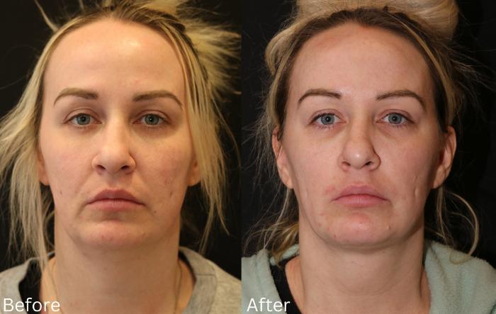 Before & After Ellevate Neck Contouring Case 65 View 1 View in Santa Rosa, California