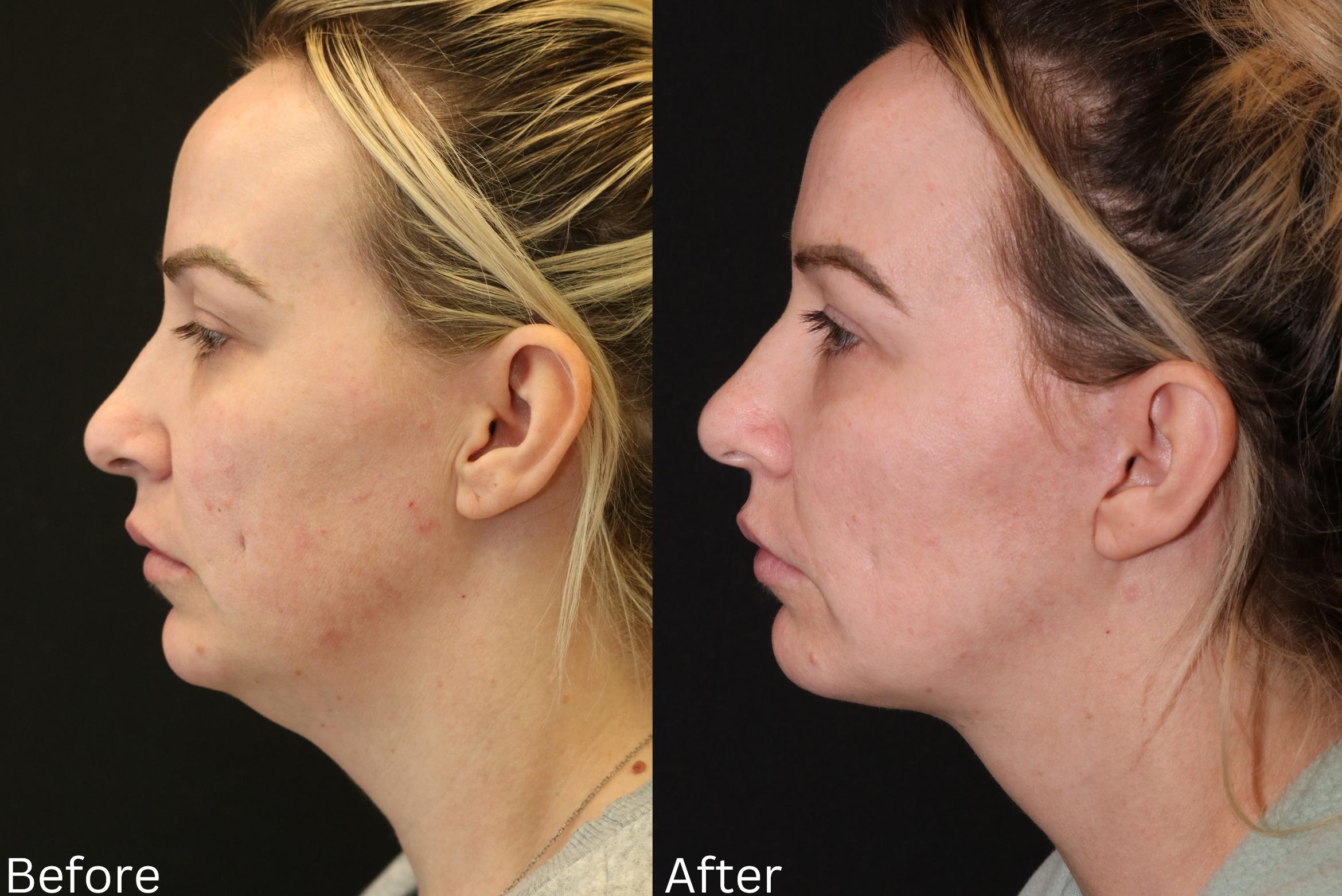 Before & After Ellevate Neck Contouring Case 65 View 2 View in Santa Rosa, California