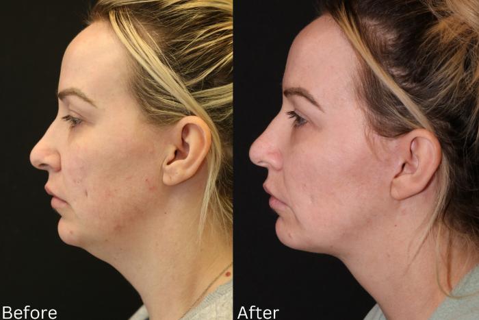 Before & After Ellevate Neck Contouring Case 65 View 2 View in Santa Rosa, California
