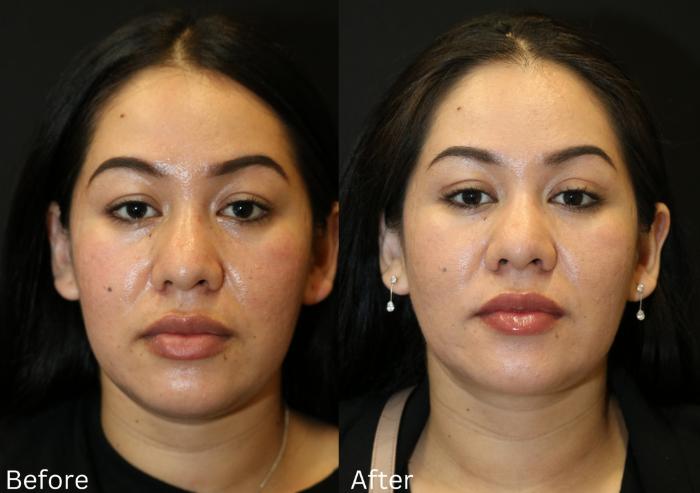 Before & After Ellevate Neck Contouring Case 66 View 1 View in Santa Rosa, California