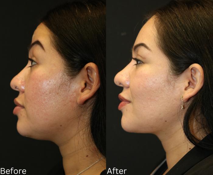 Before & After Ellevate Neck Contouring Case 66 View 2 View in Santa Rosa, California