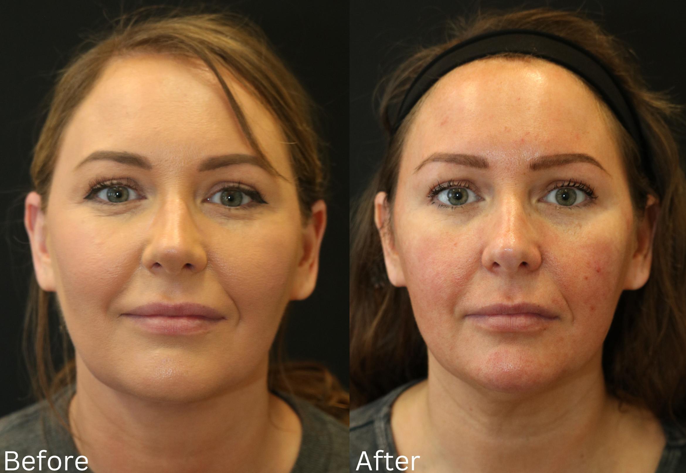 Before & After Ellevate Neck Contouring Case 67 View 1 View in Santa Rosa, California