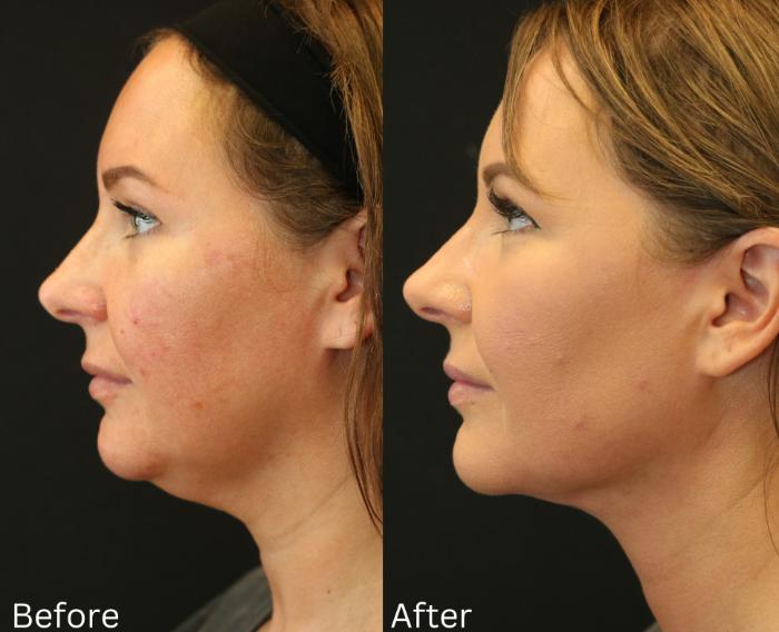 Before & After Ellevate Neck Contouring Case 67 View 2 View in Santa Rosa, California
