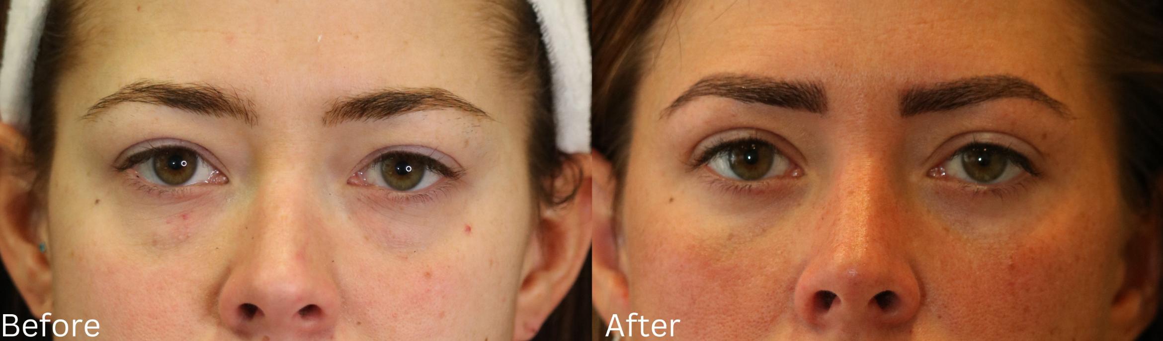 Before & After Eyelid Lift Case 171 View 1 View in Santa Rosa, California