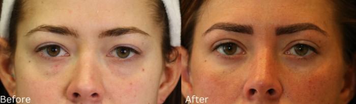 Before & After Eyelid Lift Case 171 View 1 View in Santa Rosa, California