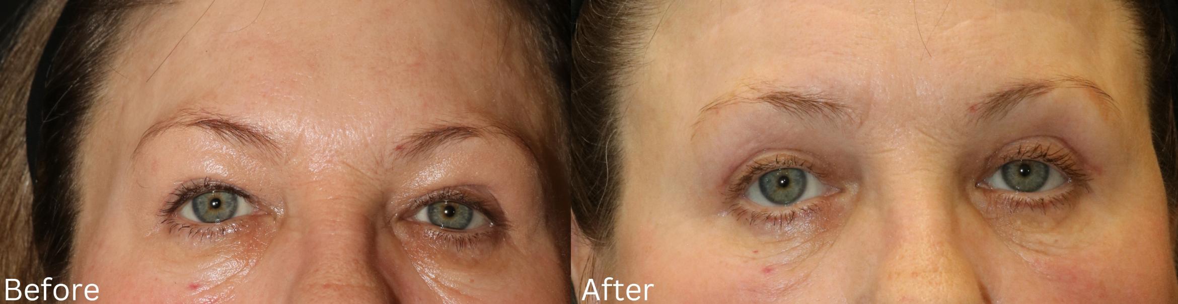 Before & After Eyelid Lift Case 172 View 1 View in Santa Rosa, California