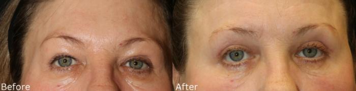 Before & After Eyelid Lift Case 172 View 1 View in Santa Rosa, California
