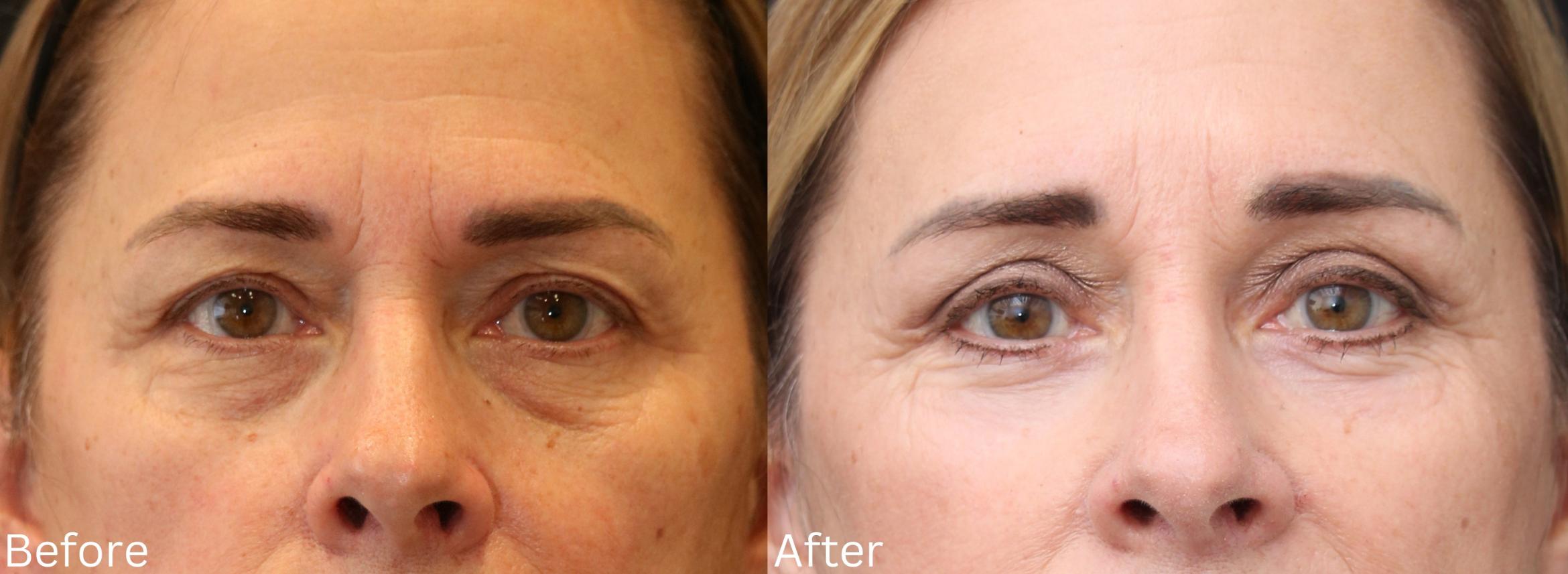 Before & After Eyelid Lift Case 173 View 1 View in Santa Rosa, California