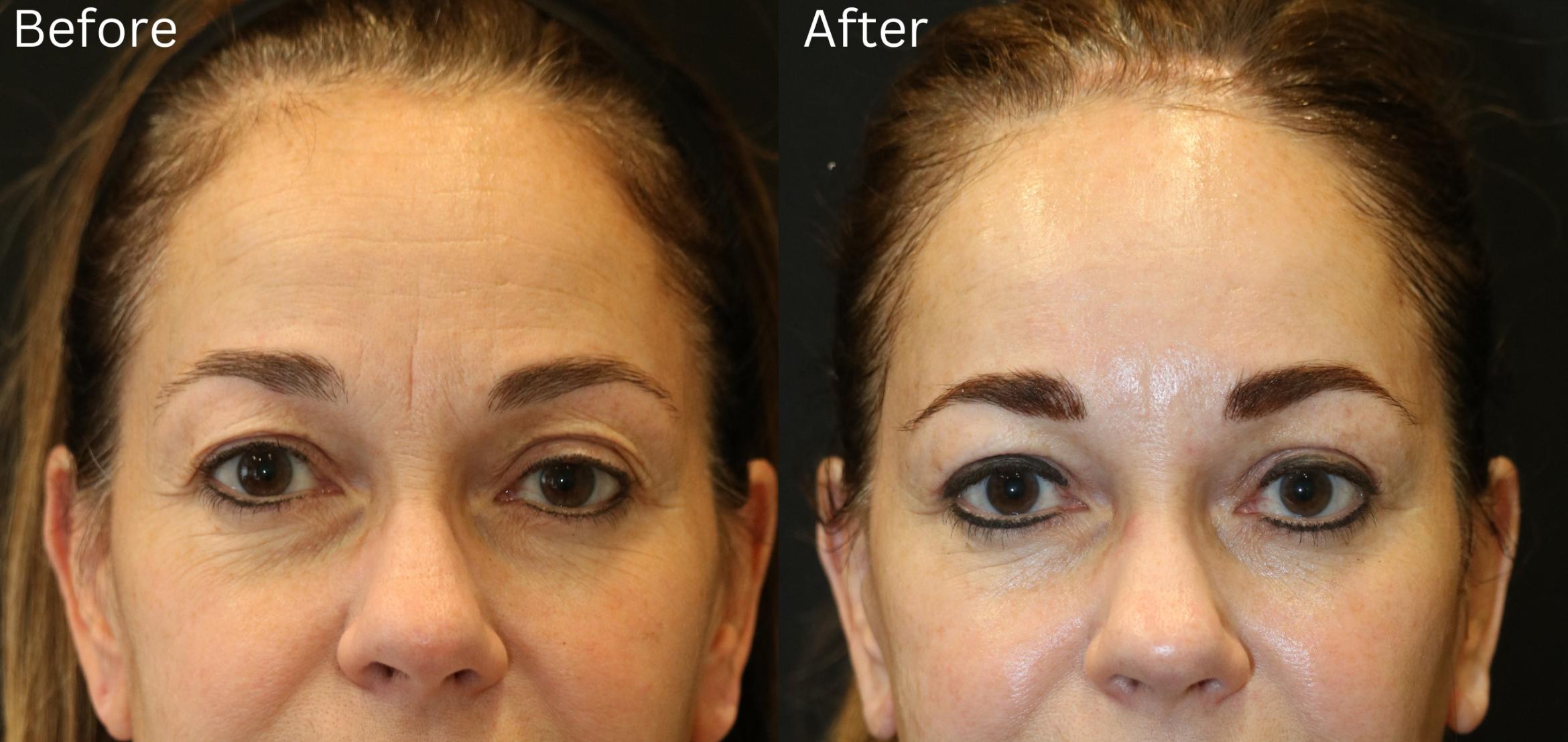 Before & After Eyelid Lift Case 174 View 1 View in Santa Rosa, California