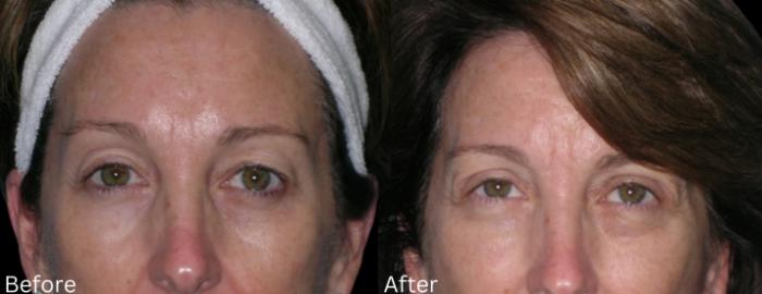 Before & After Eyelid Lift Case 19 View 1 View in Santa Rosa, California