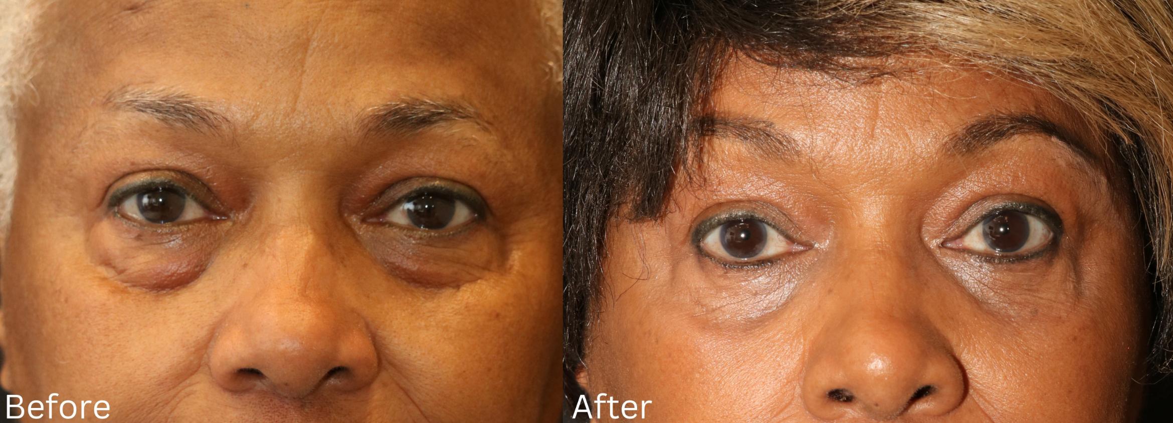Before & After Eyelid Lift Case 20 View 1 View in Santa Rosa, California