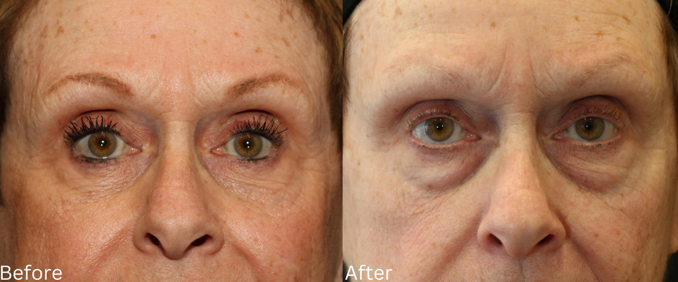 Before & After Eyelid Lift Case 21 View 1 View in Santa Rosa, California