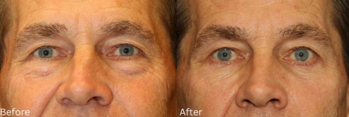 Before & After Eyelid Lift Case 22 View 1 View in Santa Rosa, California