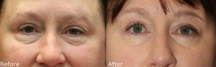 Before & After Eyelid Lift Case 23 View 1 View in Santa Rosa, California