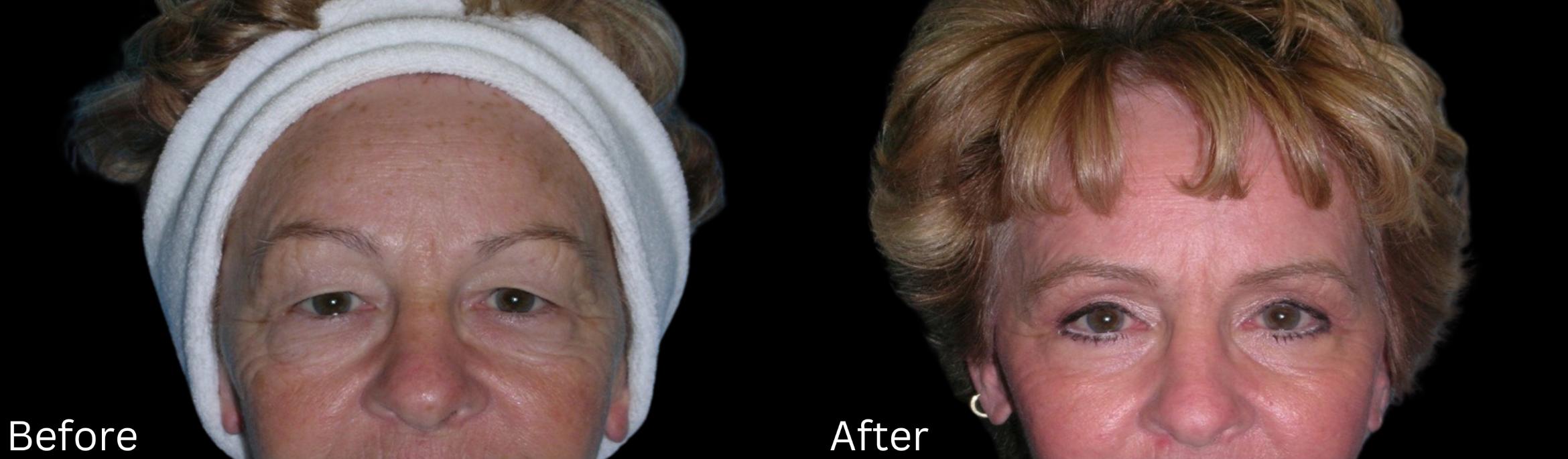 Before & After Eyelid Lift Case 239 View 1 View in Santa Rosa, California