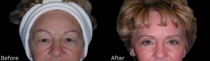 Before & After Eyelid Lift Case 239 View 1 View in Santa Rosa, California