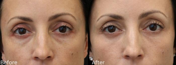 Before & After Eyelid Lift Case 24 View 1 View in Santa Rosa, California