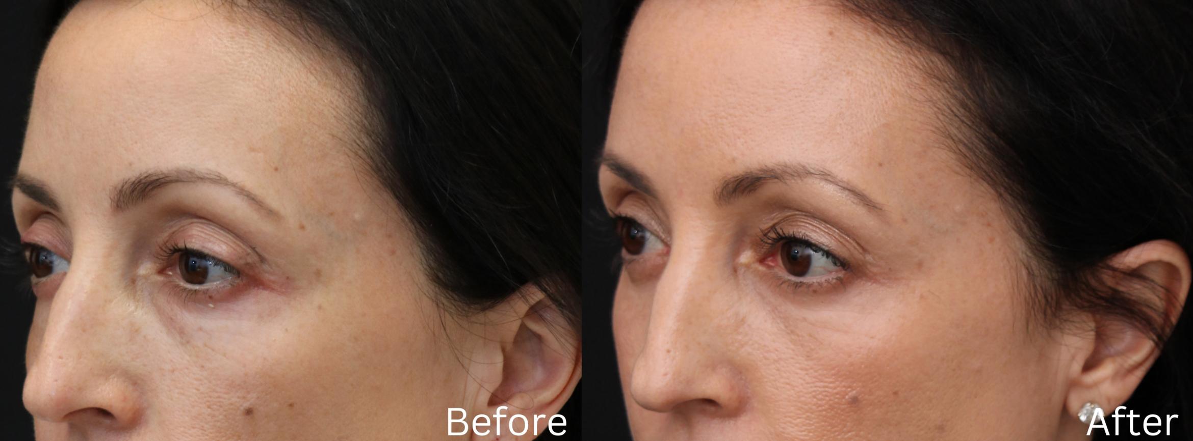 Before & After Eyelid Lift Case 24 View 2 View in Santa Rosa, California