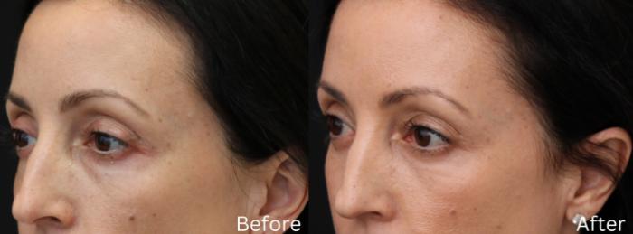 Before & After Eyelid Lift Case 24 View 2 View in Santa Rosa, California