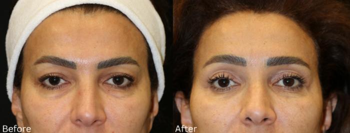 Before & After Eyelid Lift Case 240 View 1 View in Santa Rosa, California